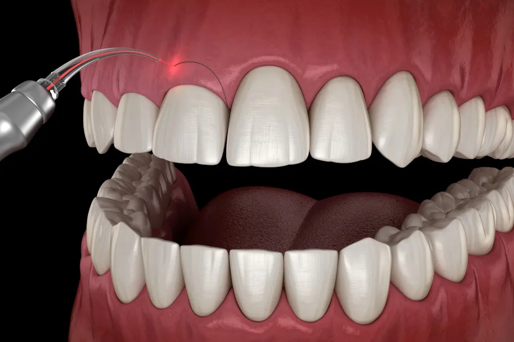 Gingivectomía estética